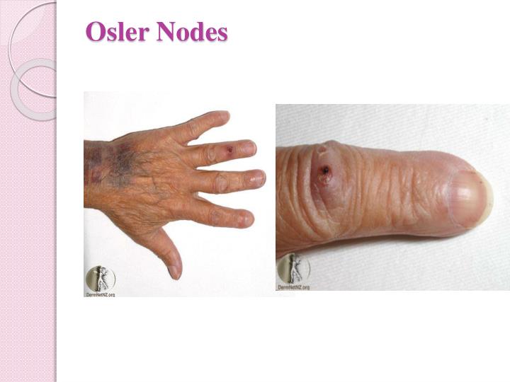 ppt infective endocarditis powerpoint presentation id 2253950