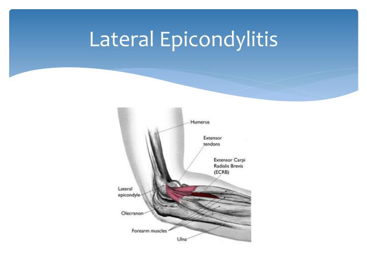 PPT PRP for Lateral Epicondylitis PowerPoint Presentation ID2258315
