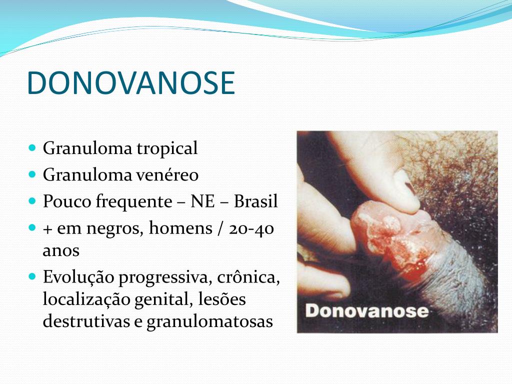 PPT - DOENÇAS SEXUALMENTE TRANSMISSÍVEIS PowerPoint Presentation, free ...