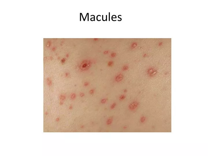 PPT Macules PowerPoint Presentation Free Download ID 2264306 PPT Macules PowerPoint Presentation Free Download ID 2264306