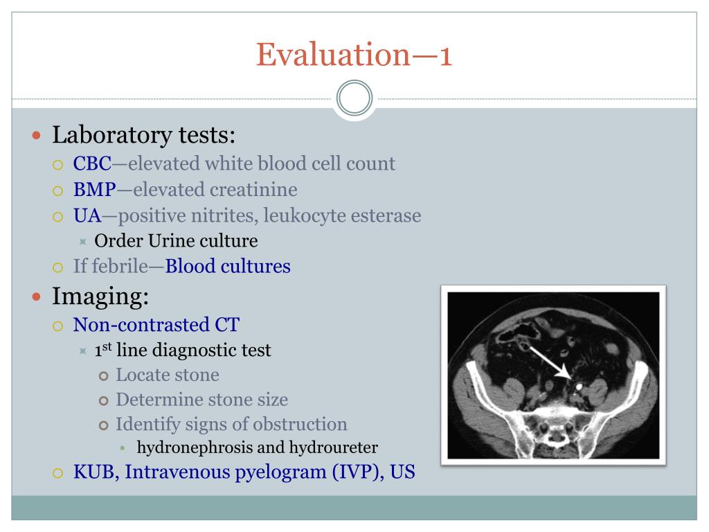 PPT - Urolithiasis : Etiology, Symptoms, And Management PowerPoint ...