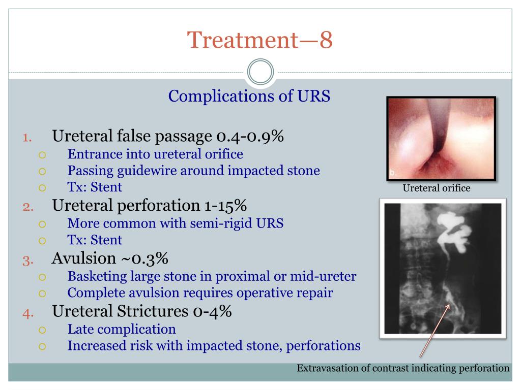 PPT - Urolithiasis : Etiology, Symptoms, And Management PowerPoint ...