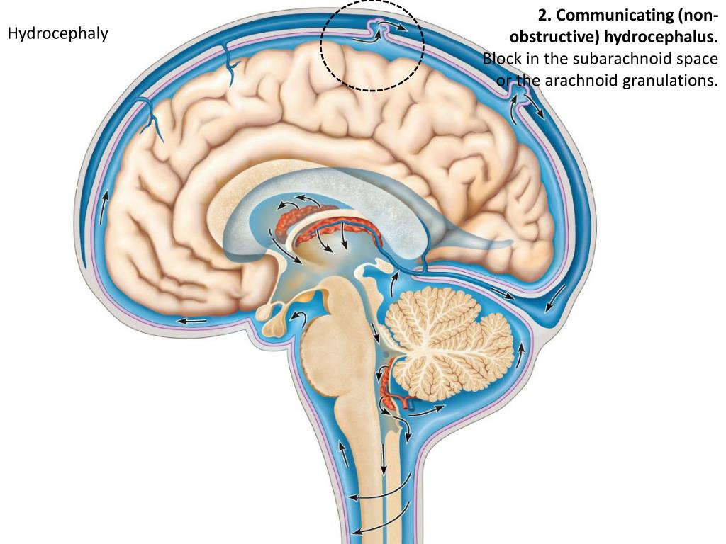 Умеренные атрофические изменения. СИЛЬВИЕВ водопровод анатомия. Гидроцефалия желудочков головного мозга. Циркуляция спинномозговой жидкости в ЦНС. СИЛЬВИЕВ водопровод мозга.