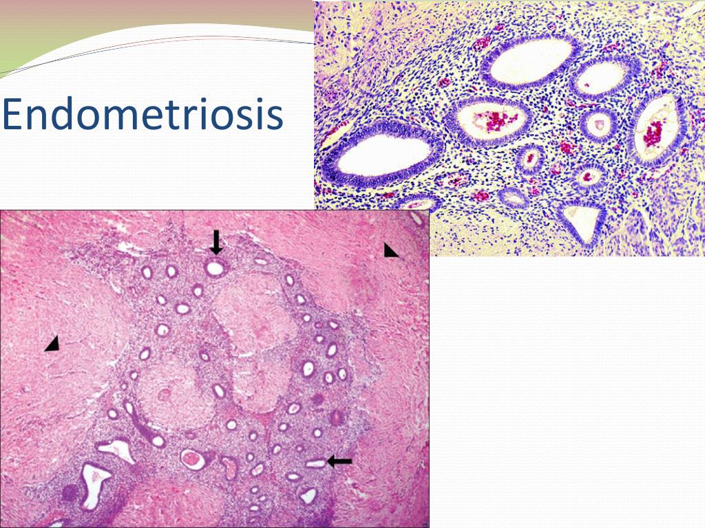 PPT - Polycystic Ovarian Disease and Endometriosis PowerPoint ...