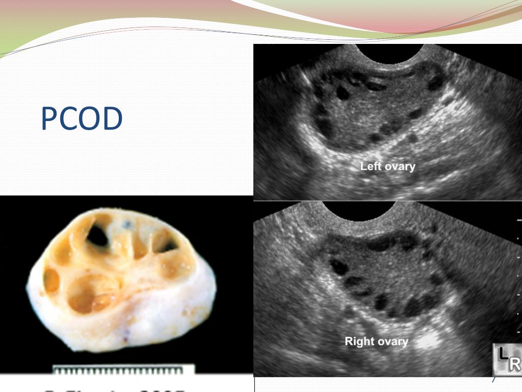 PPT - Polycystic Ovarian Disease and Endometriosis PowerPoint ...