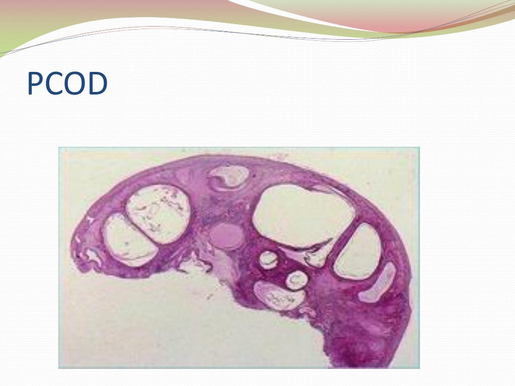 PPT - Polycystic Ovarian Disease and Endometriosis PowerPoint ...