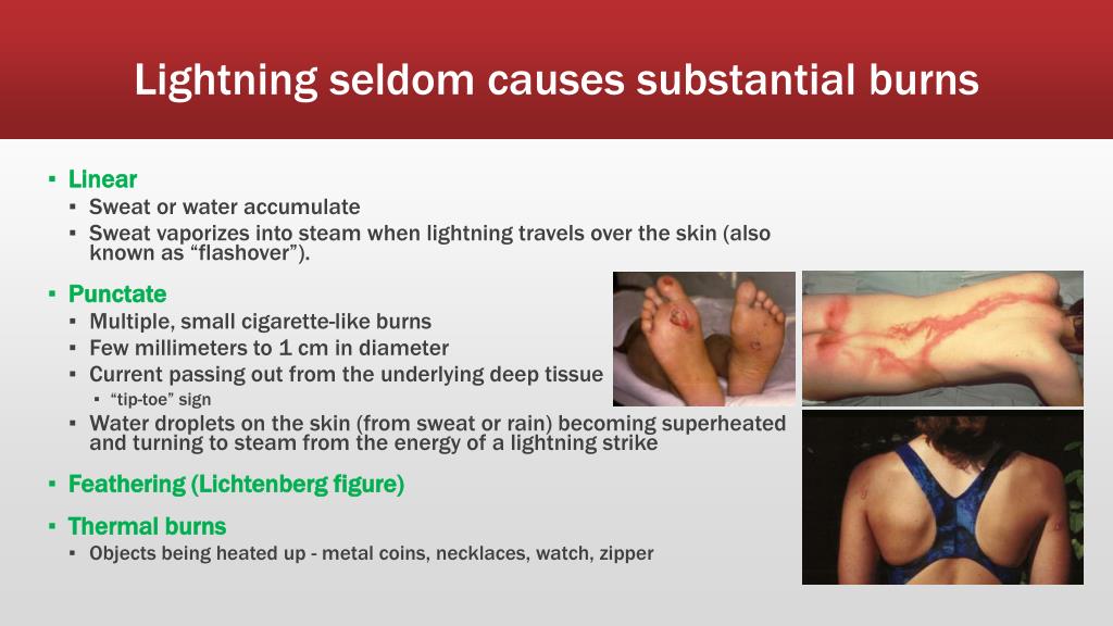 Burns Associated With Lightning Strikes Are Typically
