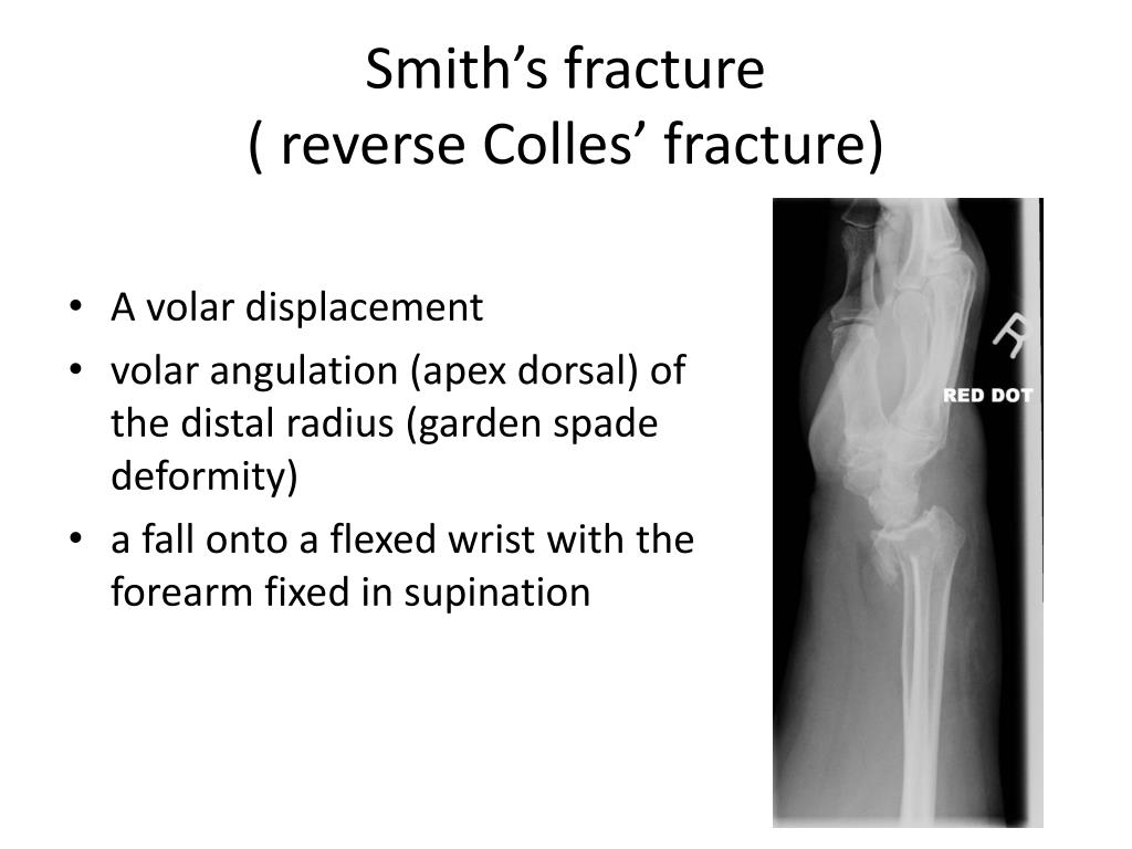 Ppt Common Fractures Powerpoint