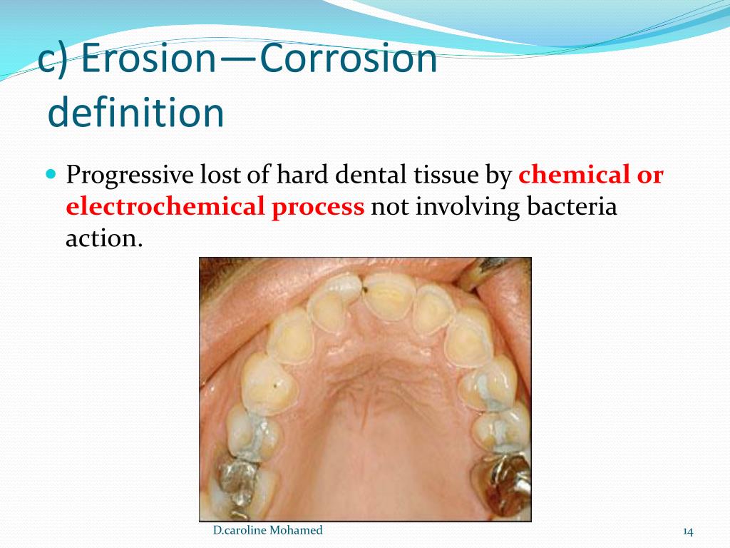 PPT Tooth wear aetiology , prevention, clinical implication