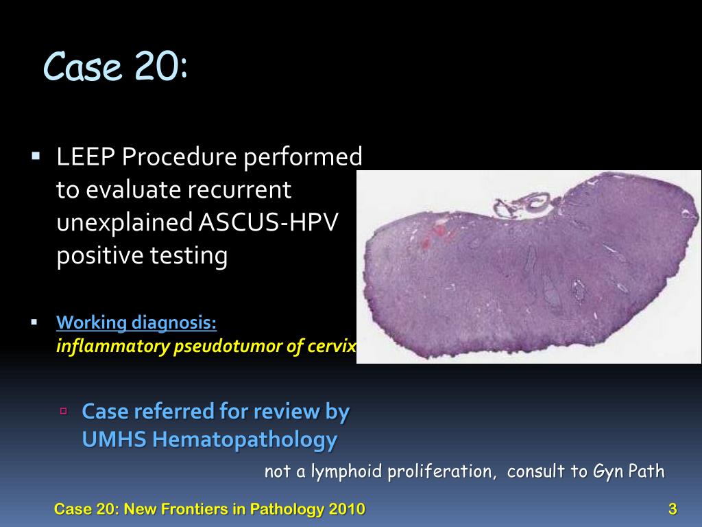 icd 10 code for ascus with high risk hpv