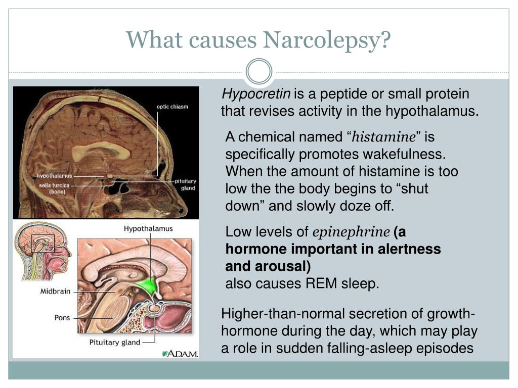 powerpoint narcolepsy with cataplexy