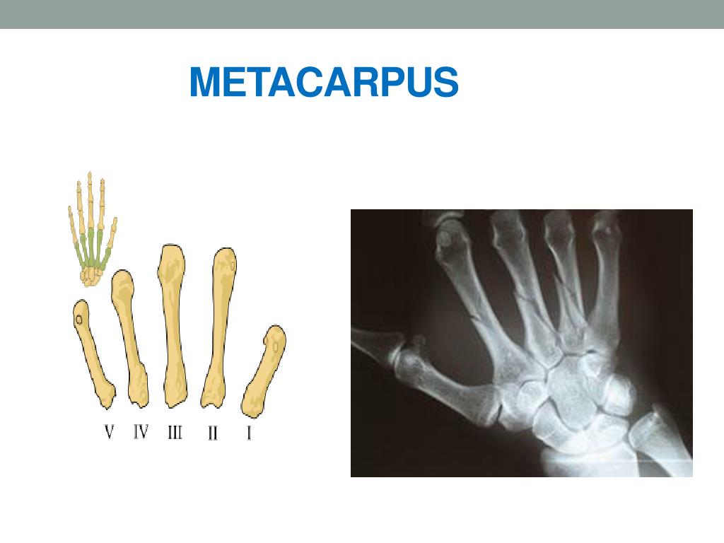 PPT - POHYBOVÝ SYSTÉM – Kostra horní končetiny III PowerPoint ...