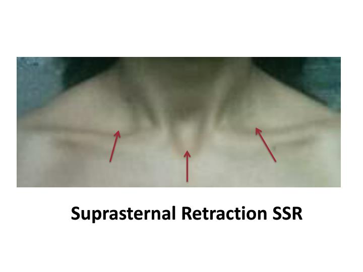 PPT An approach to Respiratory Distress in Newborn PowerPoint