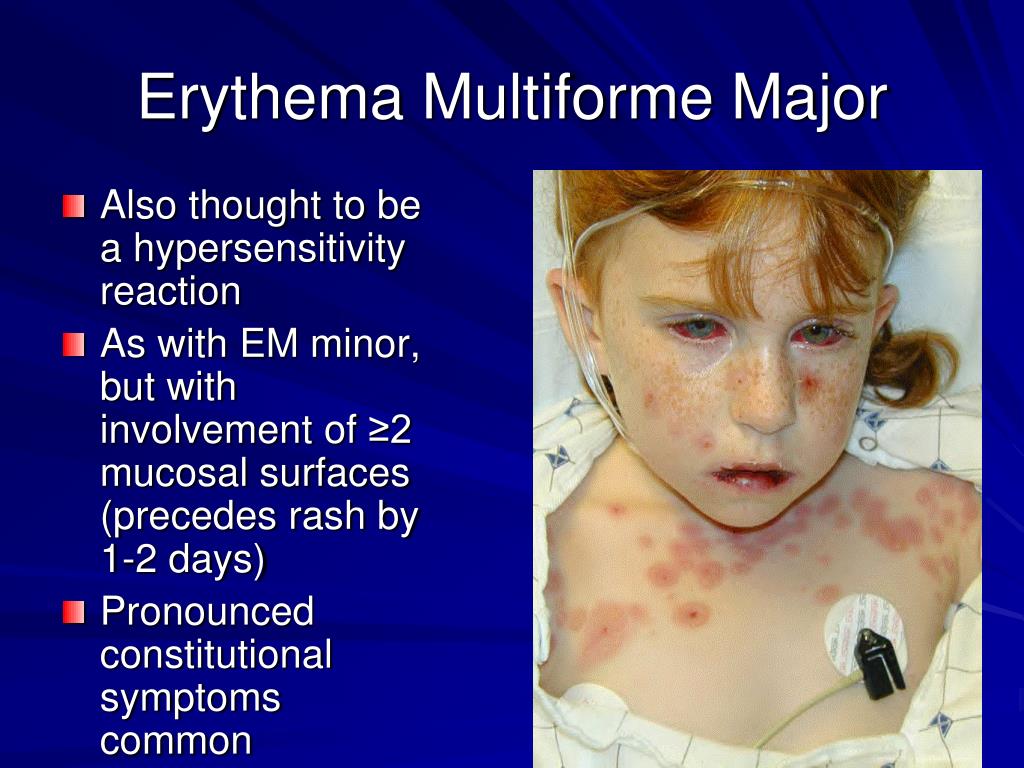 PPT - Dermatologic Manifestations of Chronic Disease PowerPoint ...