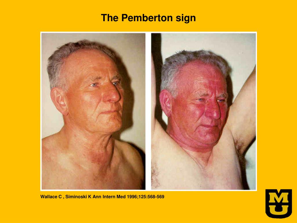 PPT THYROID DISORDERS Too Hot Too Cold Or Just Right PowerPoint PPT THYROID DISORDERS Too Hot Too Cold Or Just Right PowerPoint