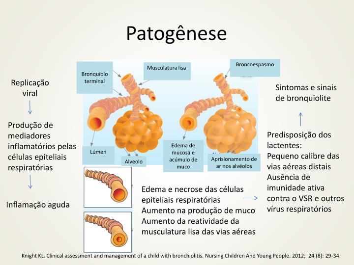 BRONQUIOLITE VIRAL AGUDA PDF