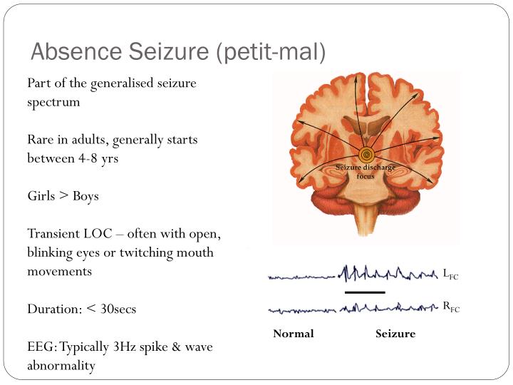 PPT Epilepsy PowerPoint Presentation ID2341272