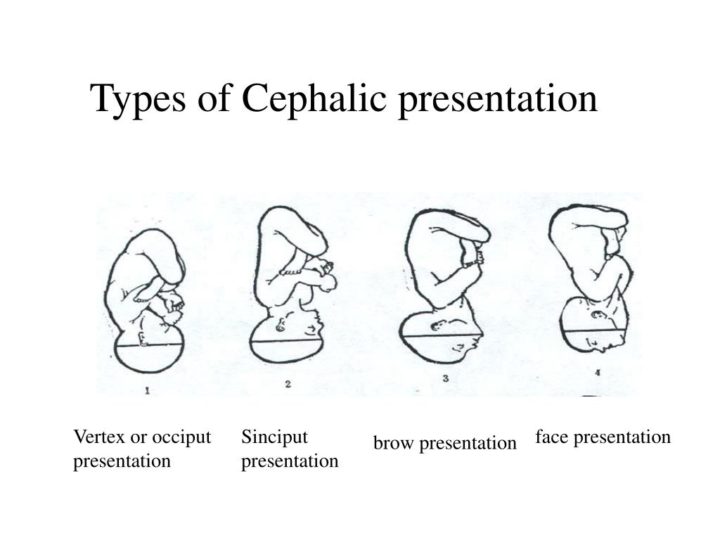 four types of cephalic presentation