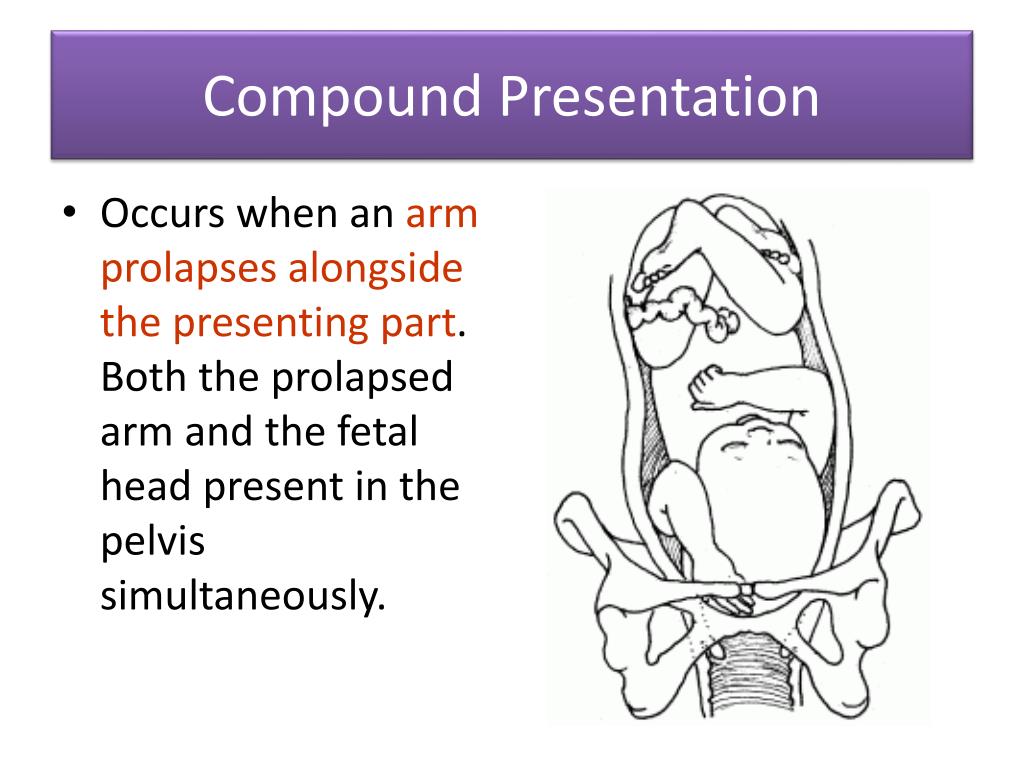 what is compound fetal presentation