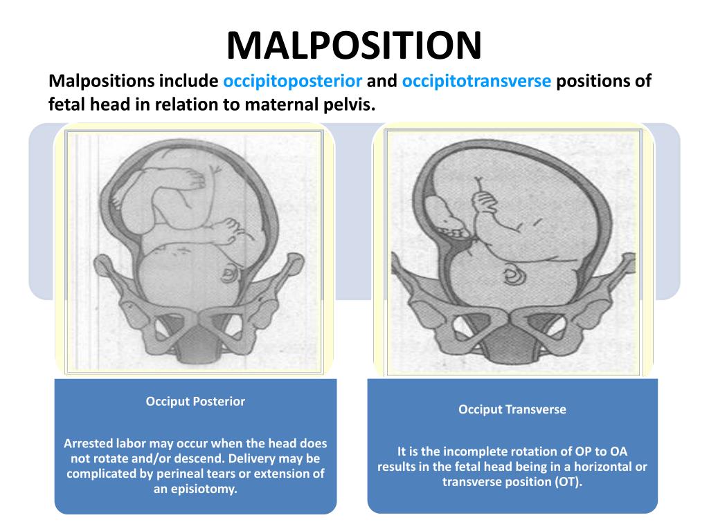 definition malpresentation fetus