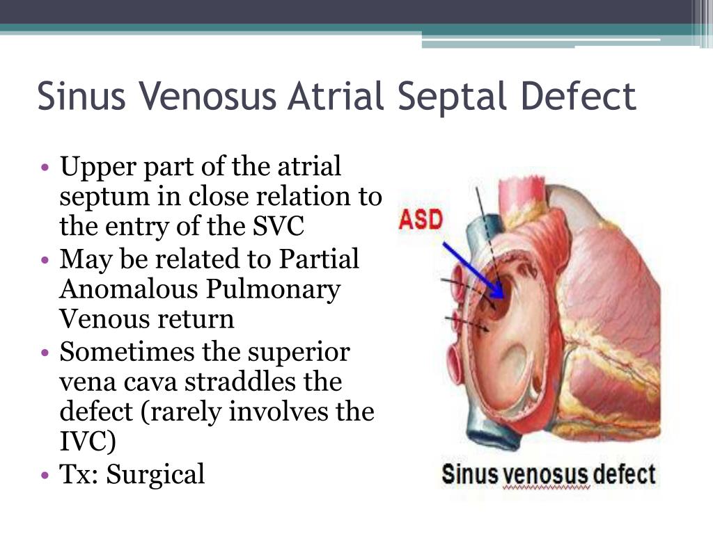PPT - CONGENITAL HEART DISEASES PowerPoint Presentation ...
Sinus Venosus Asd
