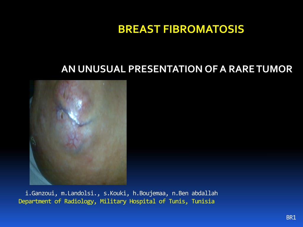 fibromatosis of breast Fibromatosis of breast