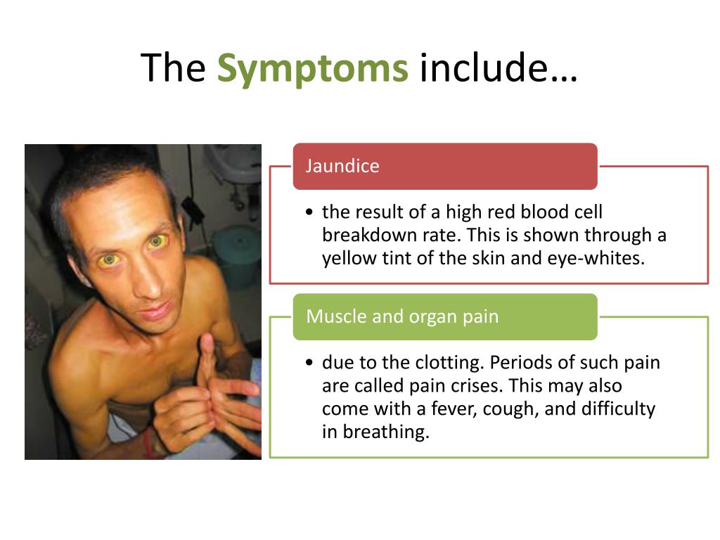 Sickle Cell Anemia Signs And Symptoms