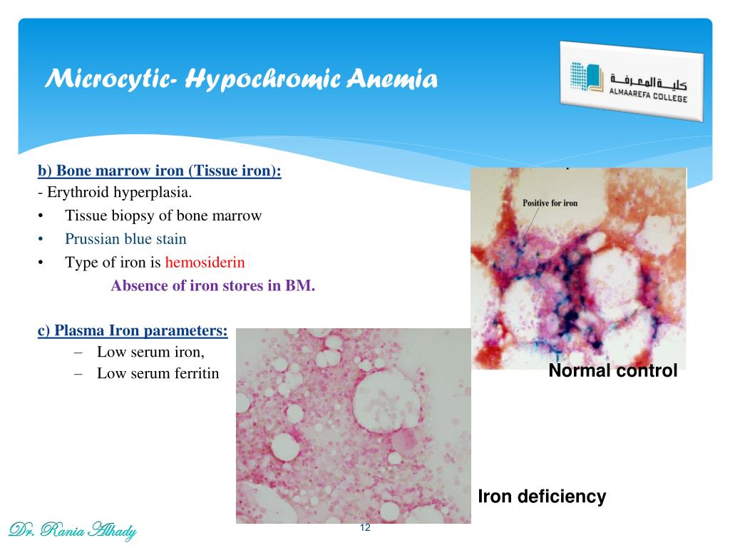 PPT - Laboratory diagnosis of Anemia PowerPoint ...