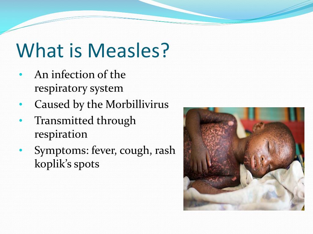 presentation on measles
