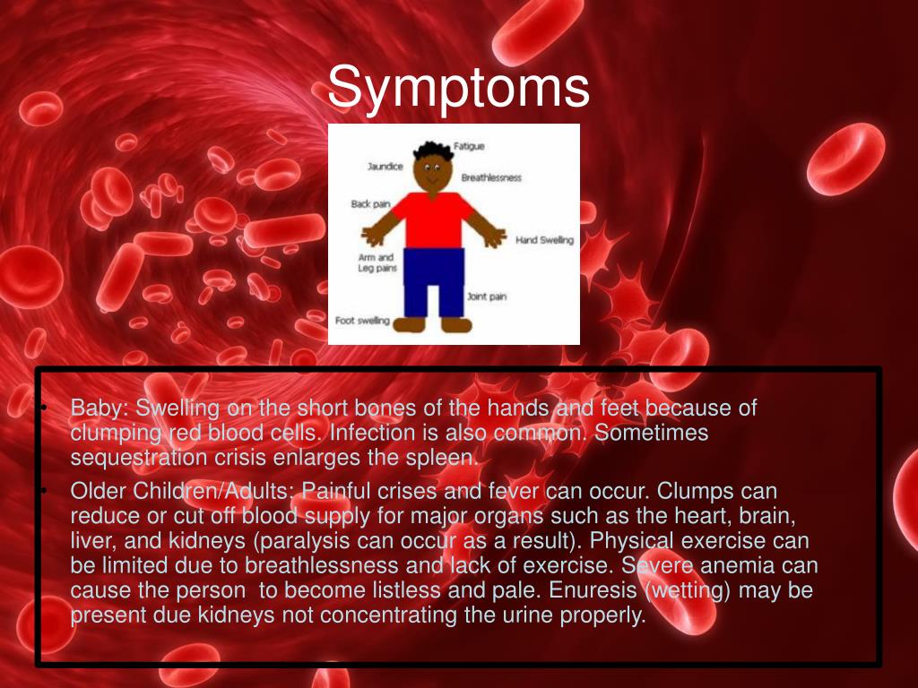 powerpoint presentation on sickle cell anemia