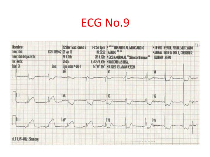 PPT - ELECTROCARDIOGRAMA EJERCICIOS PowerPoint Presentation - ID:2349619