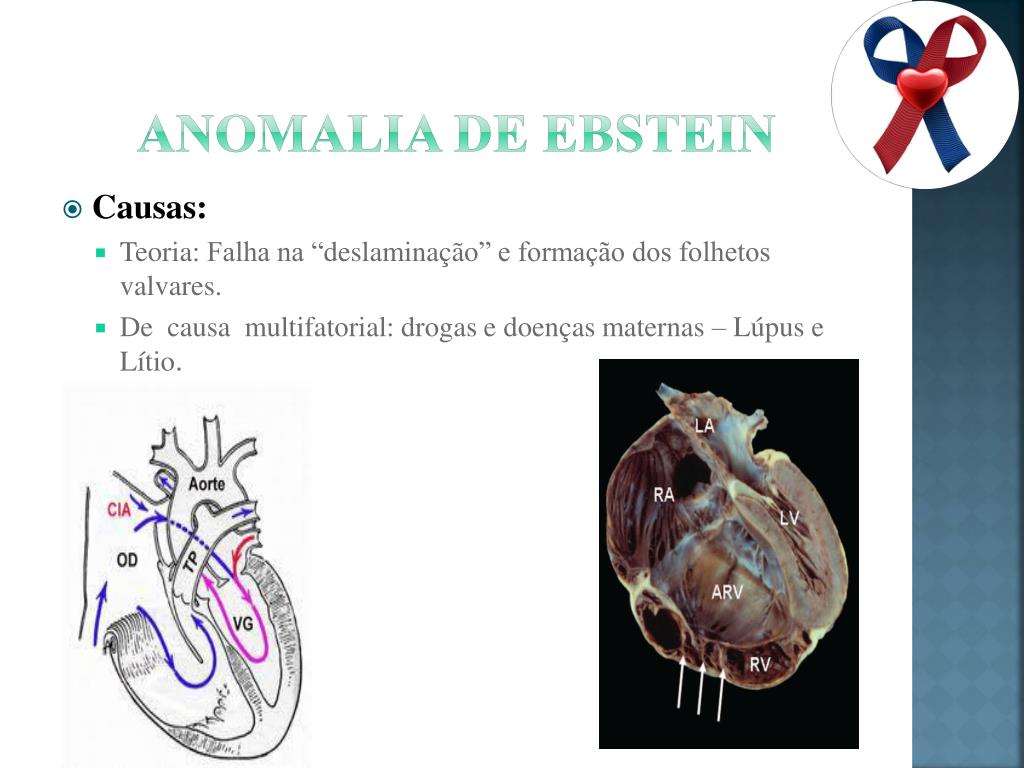 PPT - Cardiopatias Congênitas Cianogênicas PowerPoint Presentation ...