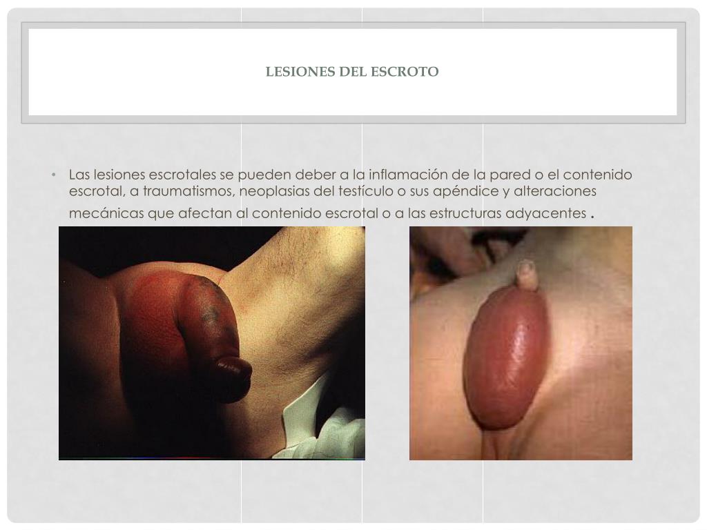 PPT - Lesiones del pene y escroto Dr. Antonio Martell Martínez R2MU  PowerPoint Presentation - ID:2353994, image size:1024x768
