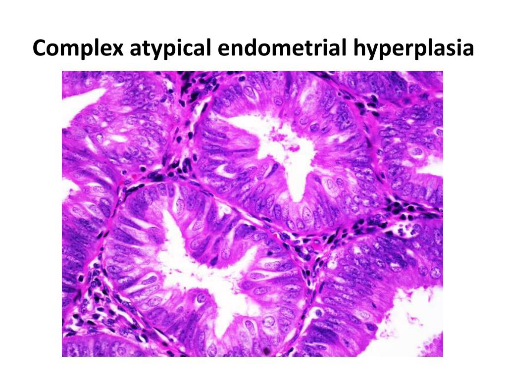 Hiperplasia endometrial premenopausia