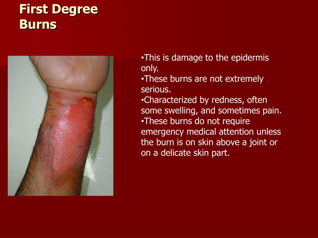 first degree burn baby