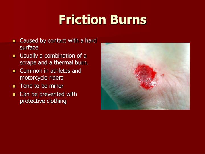 PPT Burns PowerPoint Presentation ID2358828