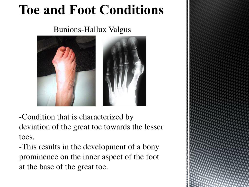 PPT - Anatomy of The Foot & Ankle PowerPoint Presentation, free ...