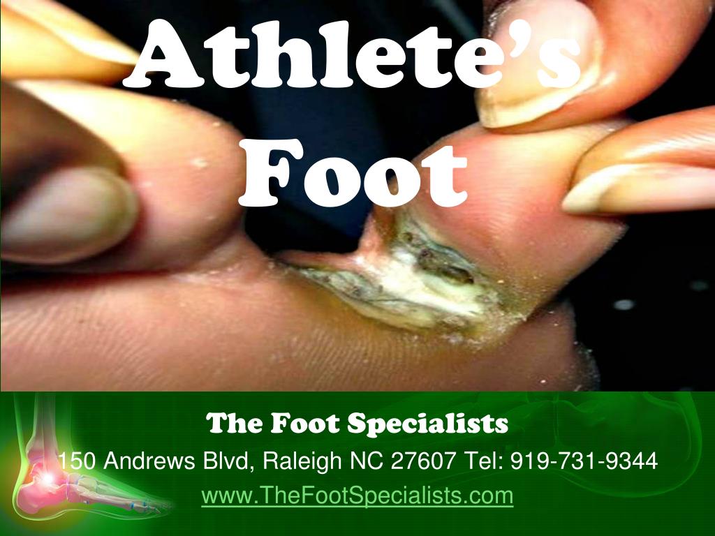 PPT Foot Diseases PowerPoint Presentation, free download ID2362938