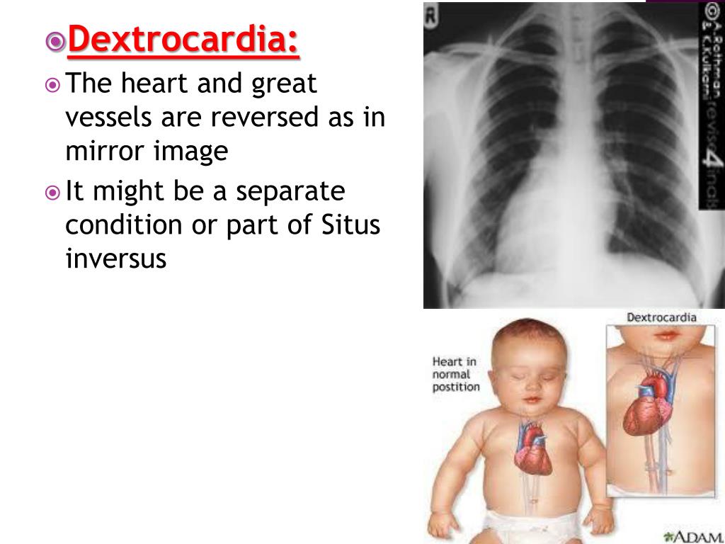 PPT - Congenital Anomalies of the heart PowerPoint Presentation, free