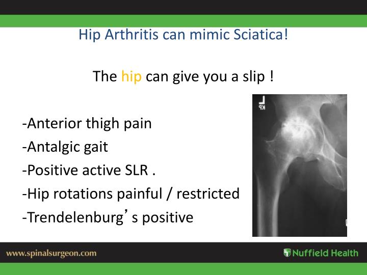 PPT - Sciatica Differential Diagnosis PowerPoint Presentation - ID:2368999