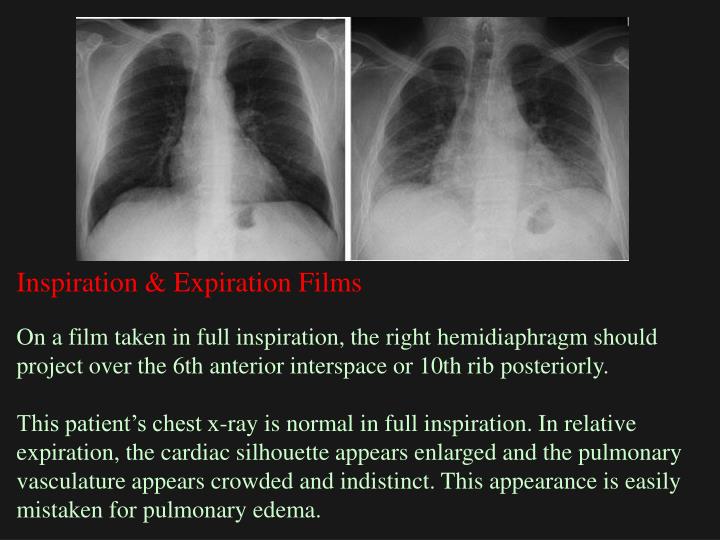 PPT Chest XRay Basic Interpretation PowerPoint Presentation ID2369751