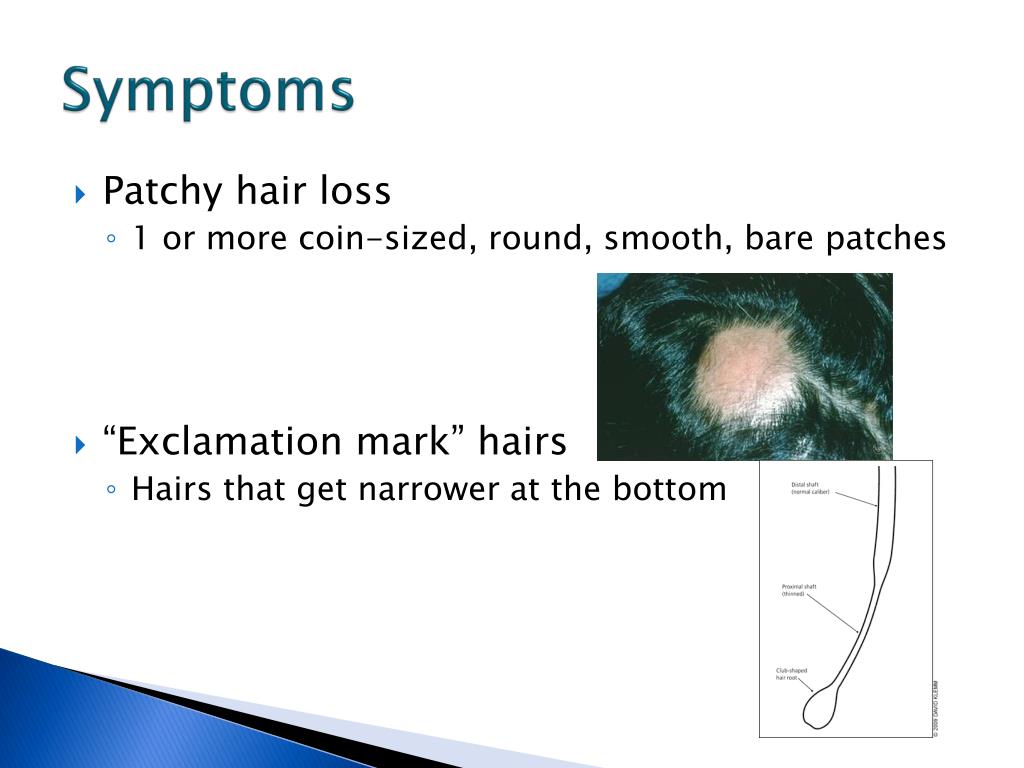 PPT - Alopecia Areata PowerPoint Presentation, free download - ID:2370984 PPT - Alopecia Areata PowerPoint Presentation, free download - ID:2370984