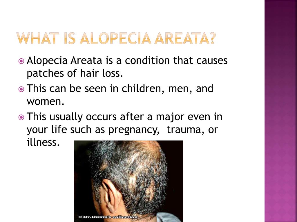 Ppt Alopecia Areata Powerpoint Presentation Free Download Id2371149