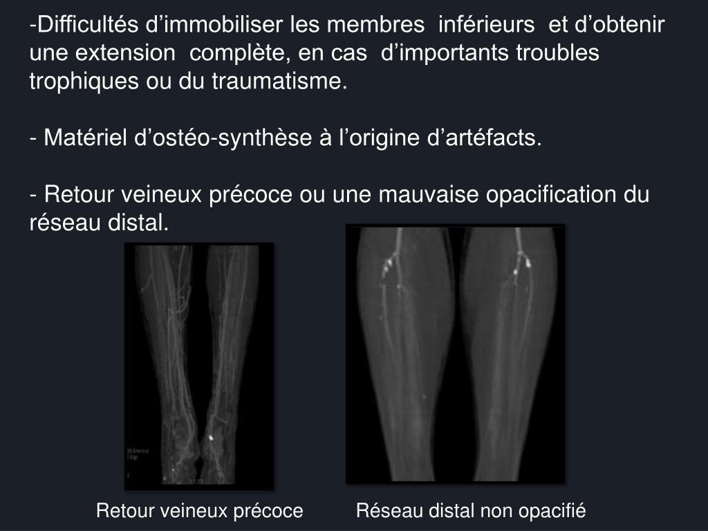 PPT Angio scanner des membres inférieurs indications, aspects normaux et pathologiques