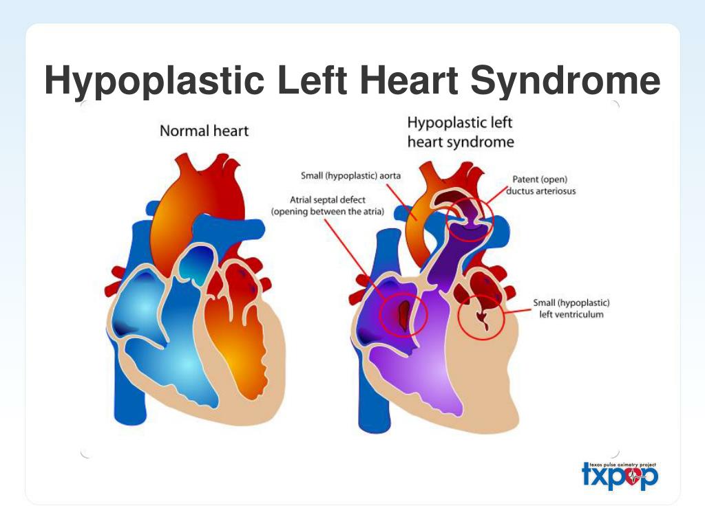 PPT - Screening for Critical Congenital Heart Disease in the Apparently ...