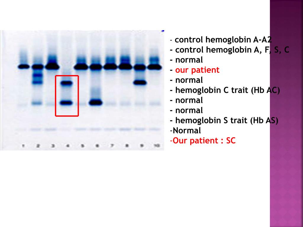 PPT Hemoglobin Electrophoresis PowerPoint Presentation, free download PPT Hemoglobin Electrophoresis PowerPoint Presentation, free download