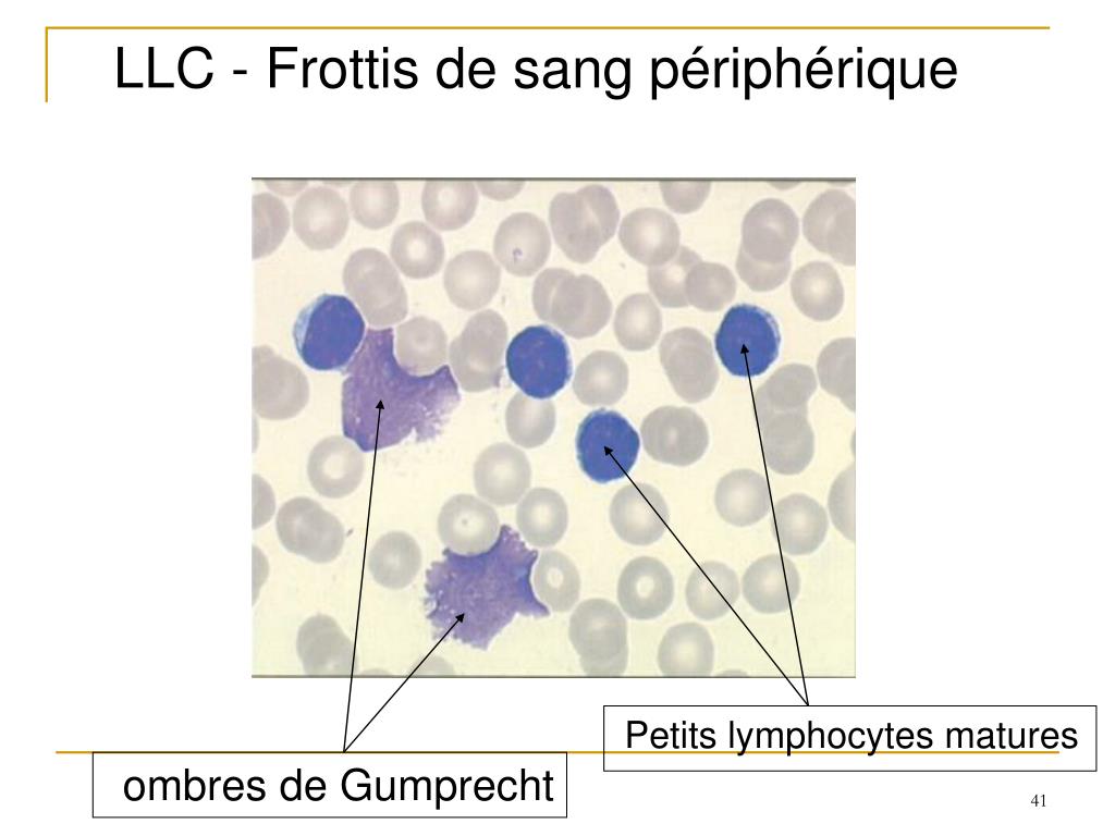 PPT - Les Hémopathies du sujet âgé PowerPoint Presentation, free download -  ID:2374285