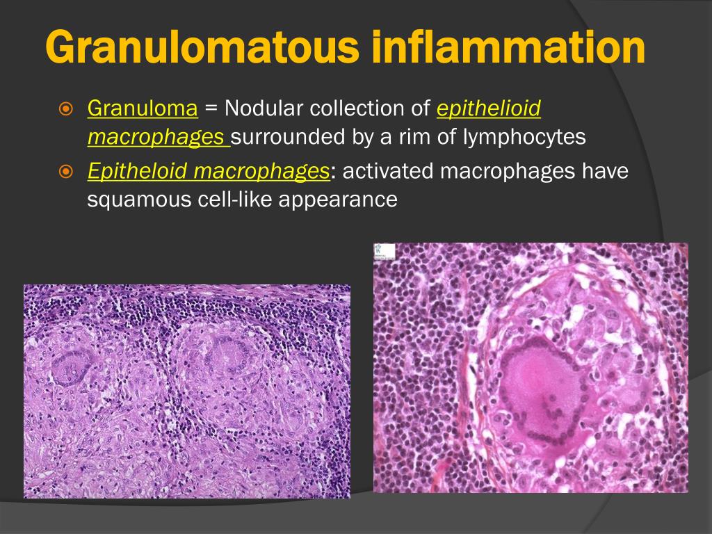 GRANULOMATOUS INFLAMMATION - Pathology Made Simple
