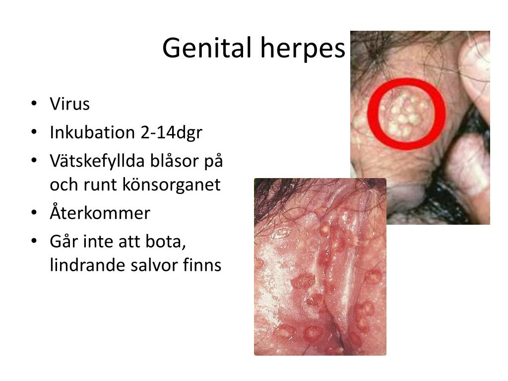 Se puede contagiar el herpes genital cuando esta inactivo