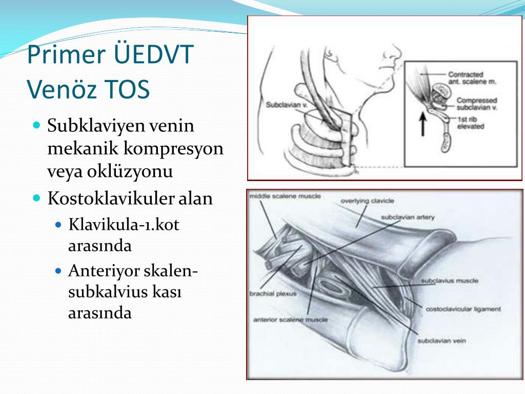 Ppt Üst Ekstremİte Derİn Ven Trombozu Powerpoint Presentation Free